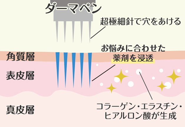 ダーマペンの治療法
