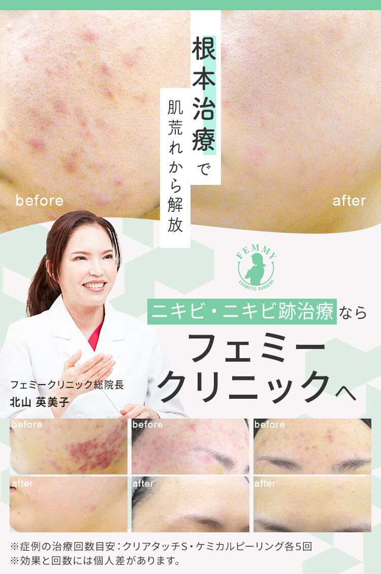 根本治療で肌荒れから解放 ニキビ・ニキビ跡治療ならフェミークリニックへ