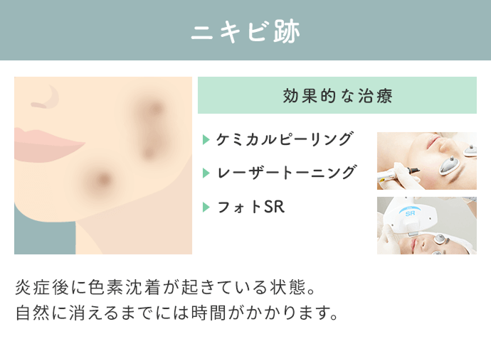 ニキビ跡