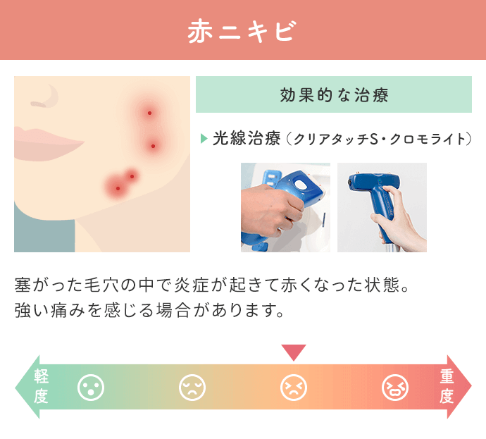 赤ニキビは塞がった毛穴の中で炎症が起きて赤くなった状態。強い痛みを感じる場合があります。