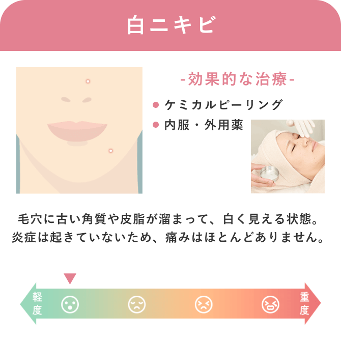 症状やニキビの種類ー白ニキビ