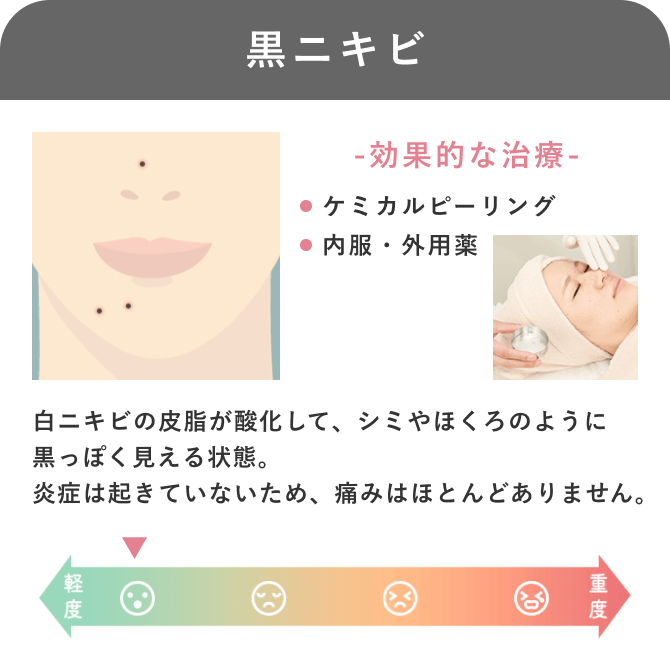 症状やニキビの種類ー黒ニキビ