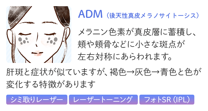 ADM（後天性真皮メラノサイトーシス）